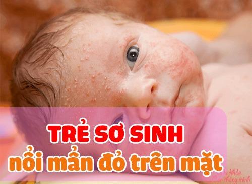 Trẻ Sơ Sinh Nổi Mẩn Đỏ Trên Mặt - Dấu Hiệu Của Trẻ Bị Viêm Da Cơ Địa