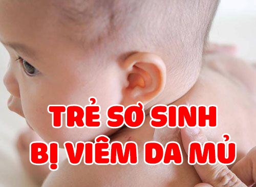 Trẻ Sơ Sinh Bị Viêm Da Mủ: Hướng Dẫn Mẹ Bí Quyết Chăm Sóc Tại Nhà