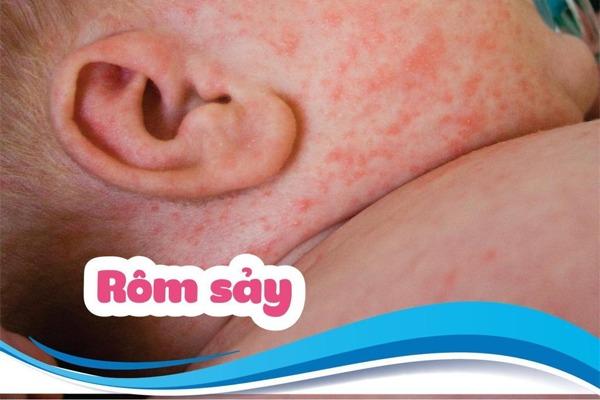 Trẻ Sơ Sinh Bị Rôm Sảy Ở Mặt: Mẹo Hay Cho Mẹ