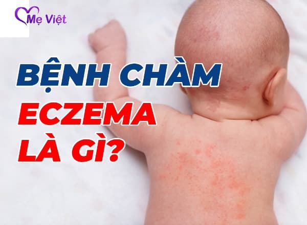 Bệnh Chàm Eczema Là Gì – Cách Nhận Biết Và Điều Trị Eczema