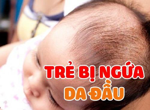 Trẻ Bị Ngứa Da Đầu Và Cách Mẹ Việt Trị Dứt Điểm