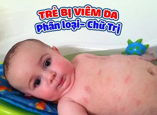 Trẻ Bị Viêm Da: Phân Loại Đúng, Chữa Trị Hiệu Quả