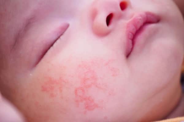 trẻ sơ sinh bị viêm da ở mặt