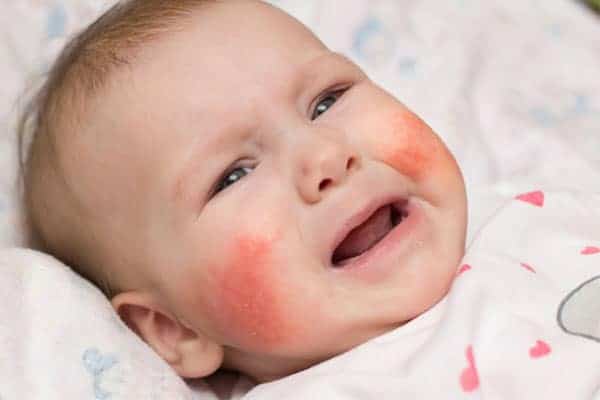 trẻ strẻ sơ sinh nổi mẩn đỏ trên mặt